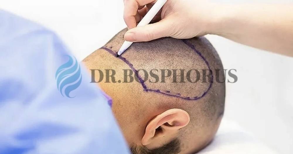 Is a Scalp Test Required Before a Hair Transplant?