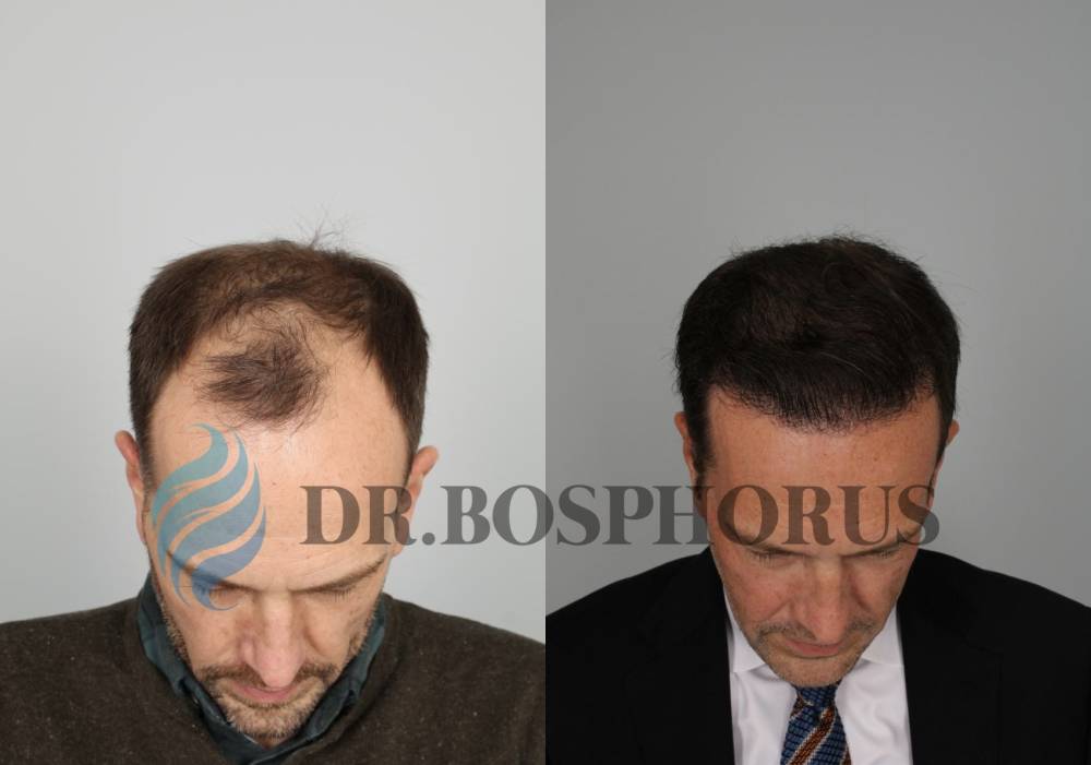 Why is Hair Angle Important in Hair Transplant Procedures? 